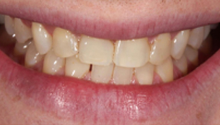 Before-before-after