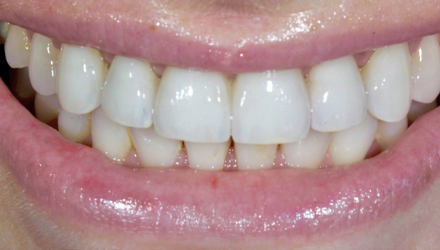 After-before-after