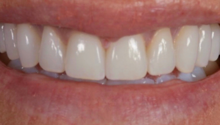 After-before-after