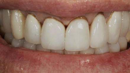 Before-before-after