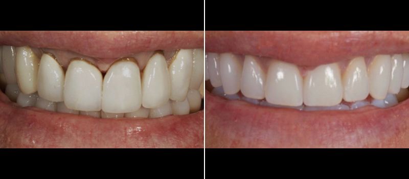 Porcelain Crowns 3 