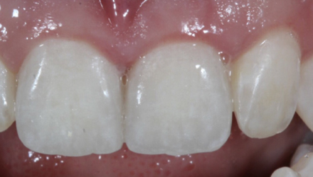 After-before-after
