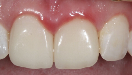 Before-before-after