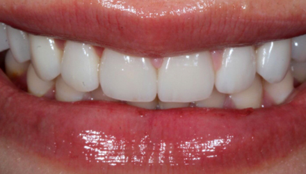 After-before-after