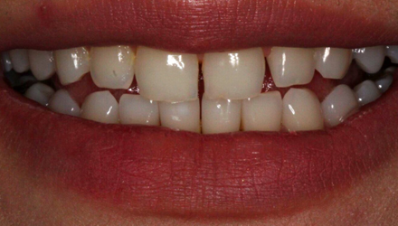 Before-before-after