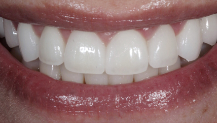 After-before-after