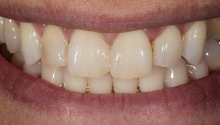 Before-before-after