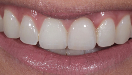 After-before-after