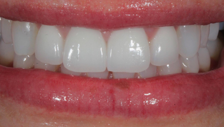After-before-after