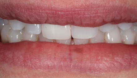 Before-before-after
