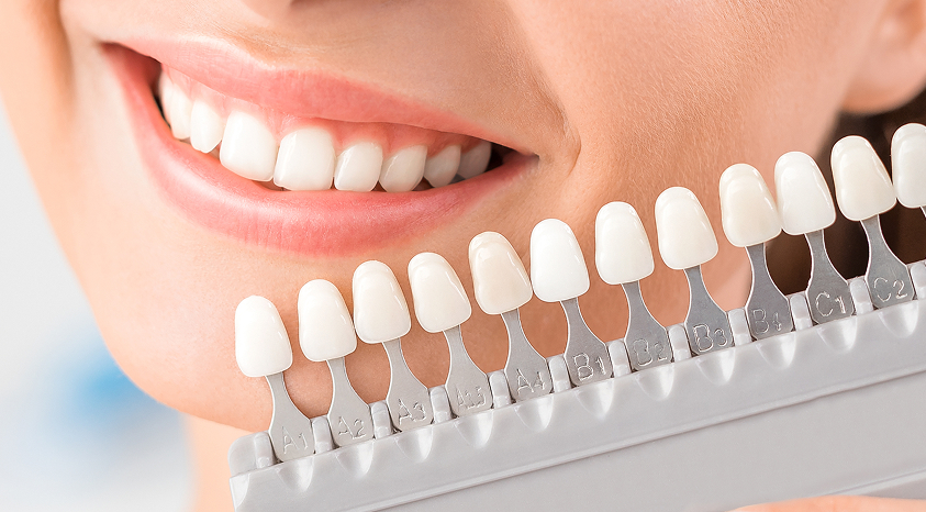 Direct Composite Veneers